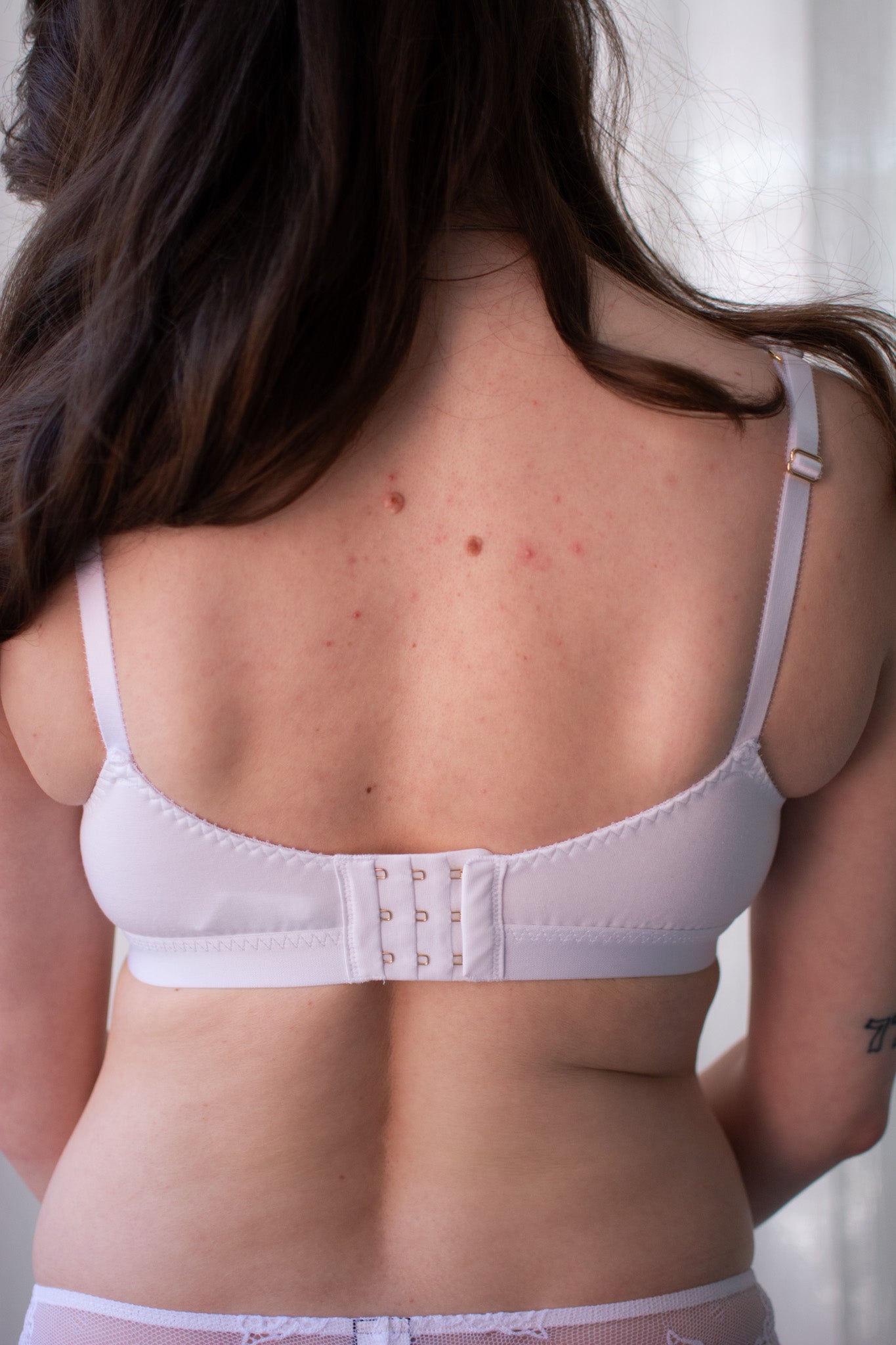 Person wearing a white bra with visible back acne on a neutral background